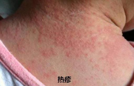 去除婴儿热疹小妙招-湿疹是一热就红一凉就不红